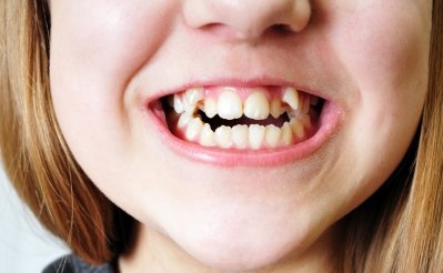 بهترین سن درمان تخصصی ارتودنسی در دختران و پسران